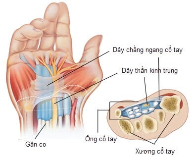 Hội chứng ống cổ tay (Carpal tunnel syndrome)