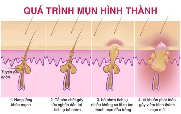 cách điều trị mụn đầu đen