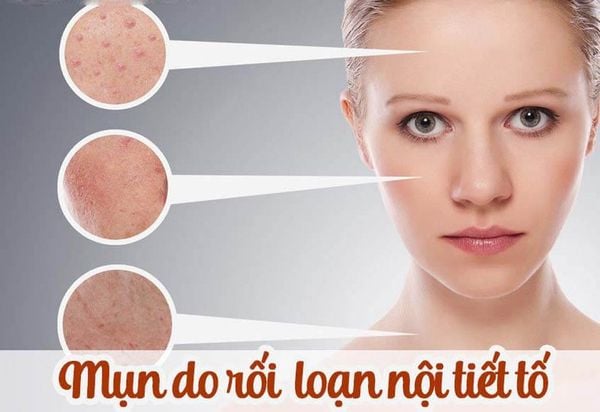 Nguyên nhân hình thành mụn trứng cá
