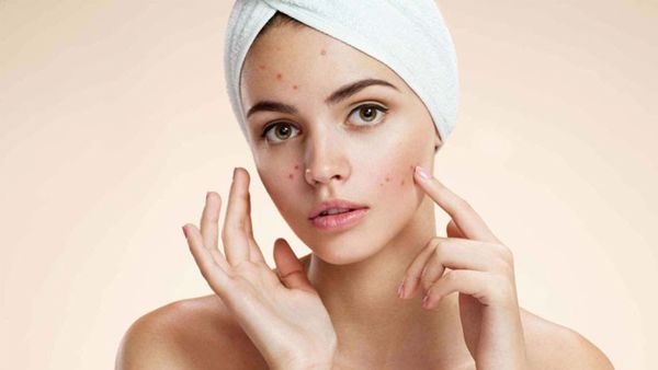 Tiêu chí chọn kem dưỡng ẩm cho da dầu mụn