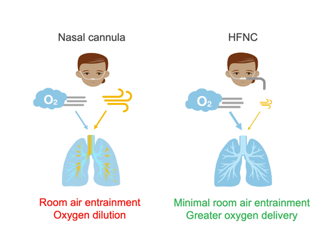 High-flow nasal cannula (HFNC) hoạt động như thế nào?