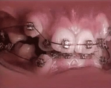 Quá trình niềng răng nha khoa medita
