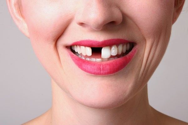 cách bảo tồn răng sau tai nạn 1