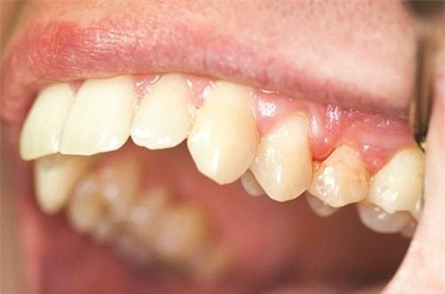 cách bảo tồn răng sau tai nạn 2