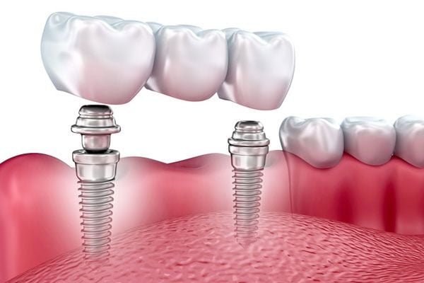 Implant nha khoa nhiều răng ở nha khoa Medita