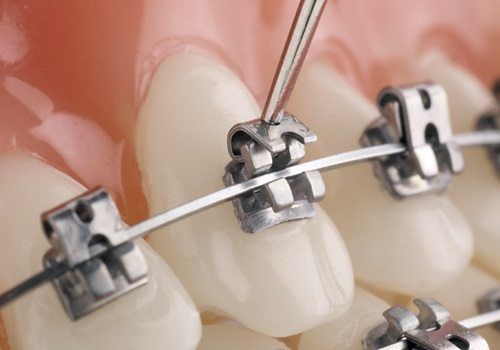 Những điều bạn cần biết về niềng răng thẩm mỹ 2
