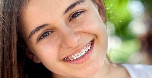 Những điều bạn cần biết về niềng răng thẩm mỹ 1