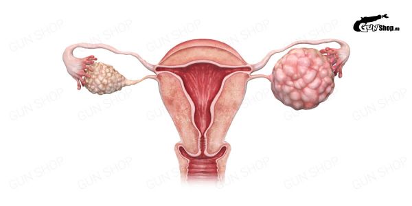 Đa nang buồng trứng có làm IVF được không? Có hiệu quả không?