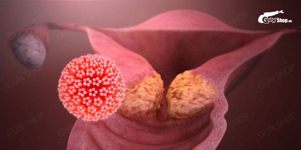 Ung thư cổ tử cung giai đoạn cuối (IV): Triệu chứng và cách điều trị