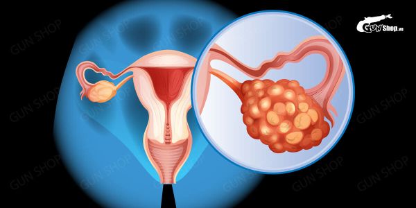 Ung thư cổ tử cung giai đoạn III là gì? Triệu chứng và cách chữa trị?