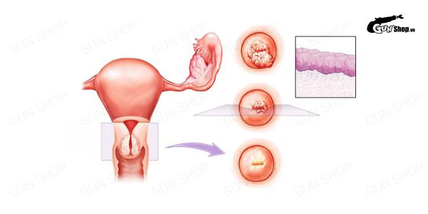 Viêm lộ tuyến cổ tử cung có biểu hiện và cách chữa trị như thế nào?