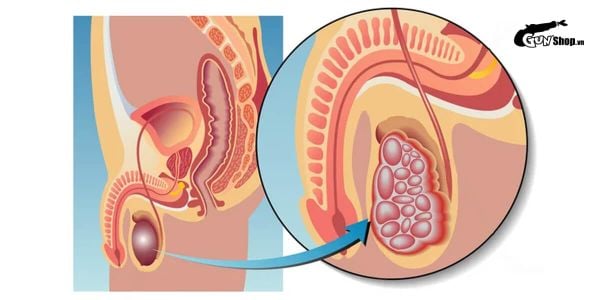 Vôi hóa tinh hoàn có nguy hiểm không? Ai là đối tượng dễ bị?