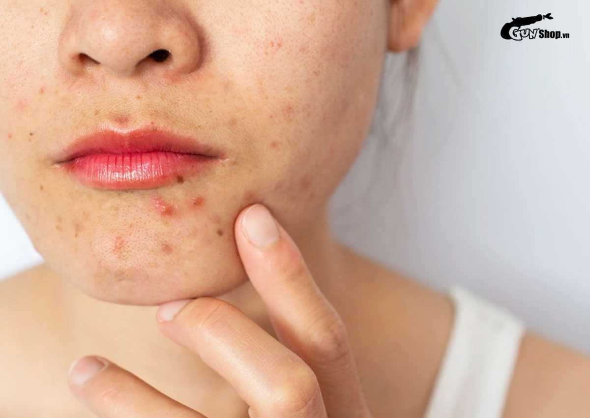 Ăn mít có nổi mụn không?