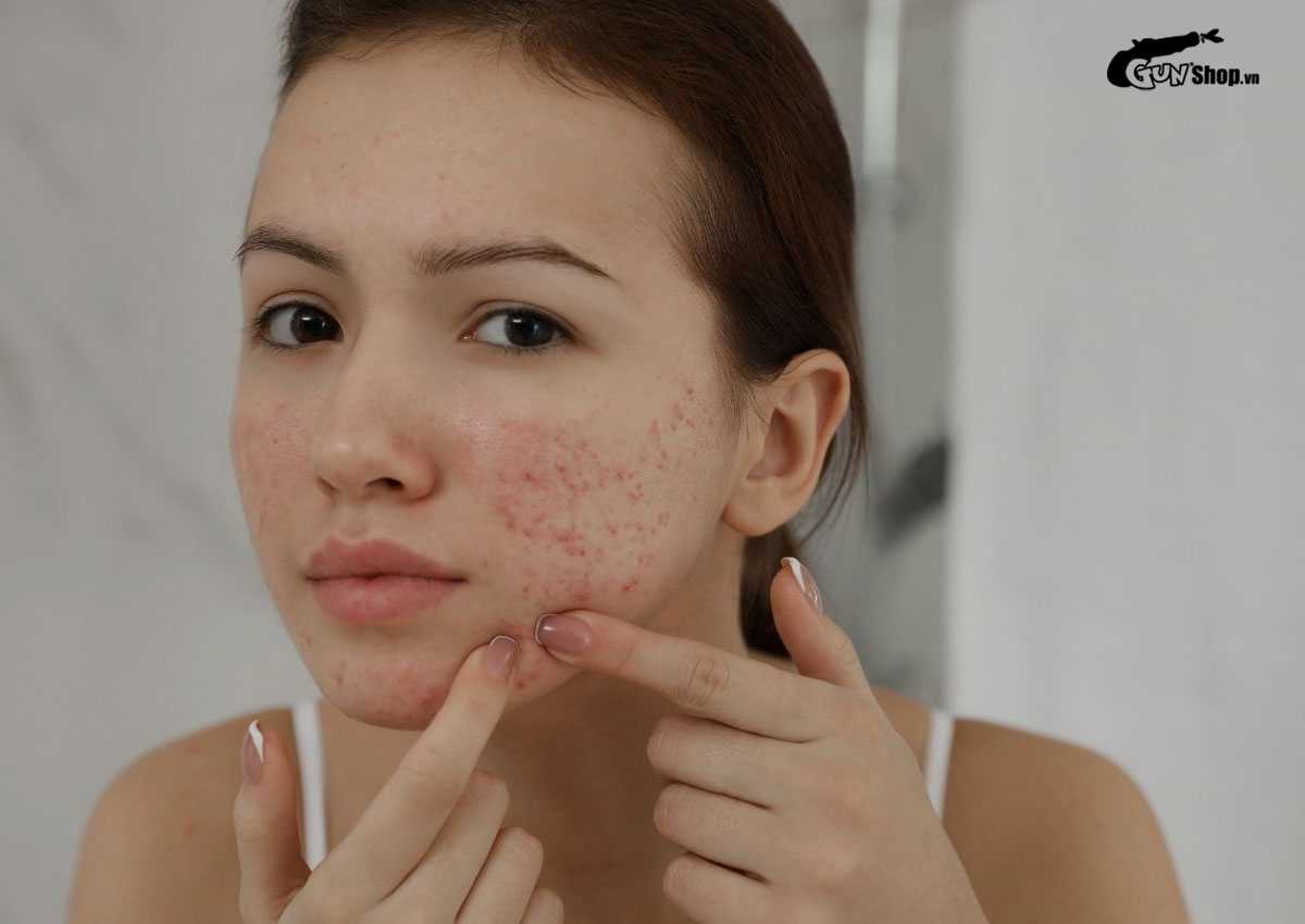 Ăn xoài có nổi mụn không?