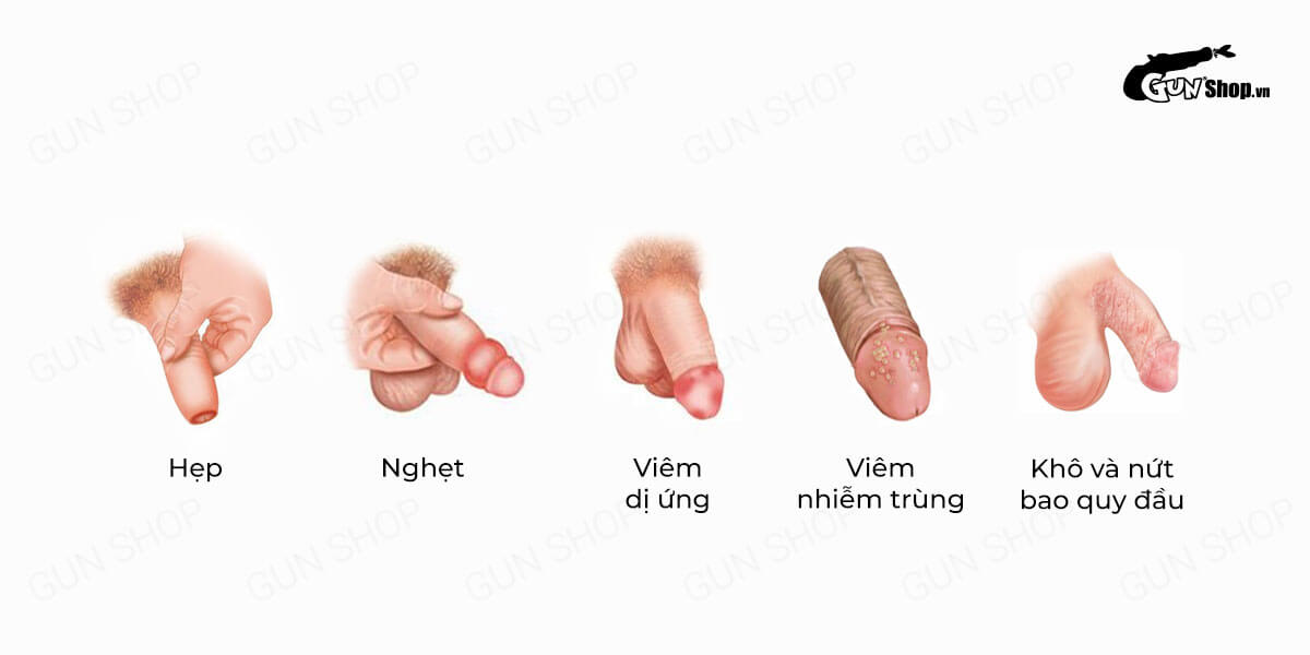 Bao quy đầu là gì? Cấu tạo, chức năng và những bệnh lý thường gặp