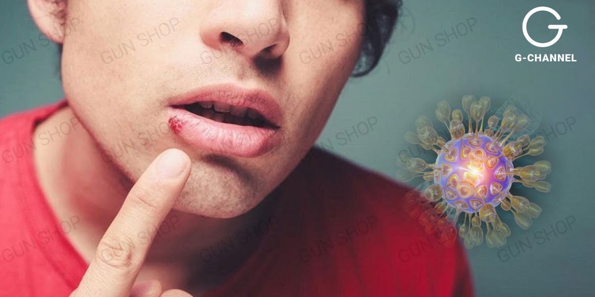 Hiểu về bệnh Herpes miệng: Nguyên nhân và dấu hiệu của bệnh