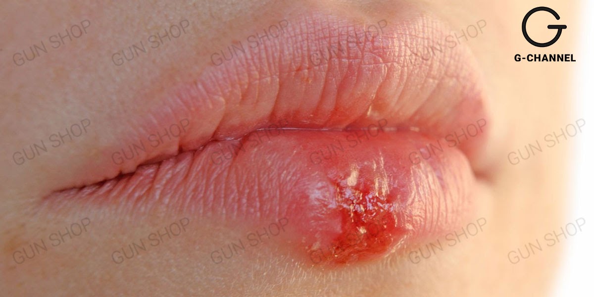 Hiểu về bệnh Herpes miệng: Nguyên nhân và dấu hiệu của bệnh