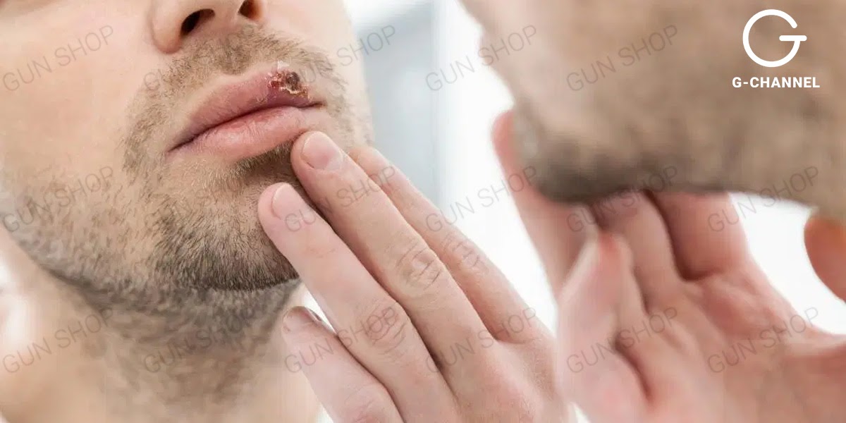Hiểu về bệnh Herpes miệng: Nguyên nhân và dấu hiệu của bệnh