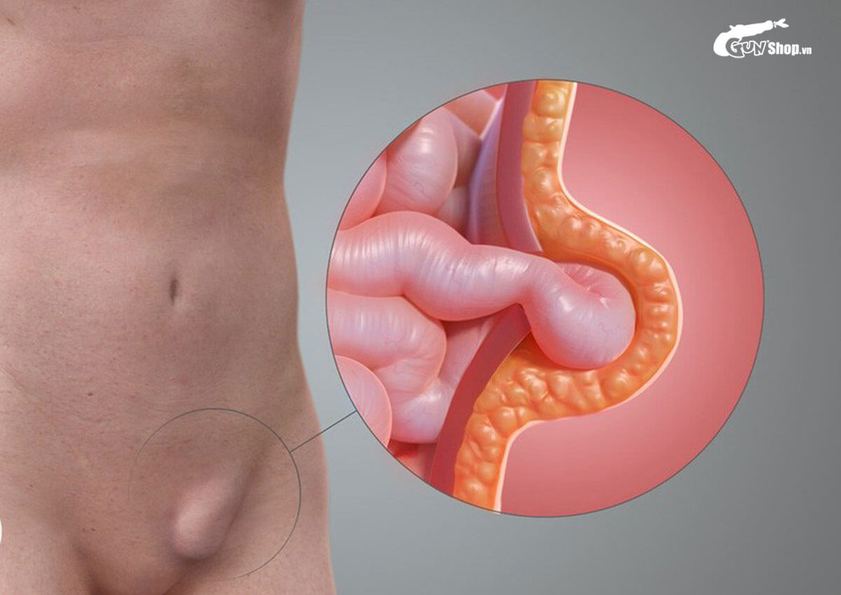 Bệnh lý ống phúc tinh mạc có thuộc nhóm bệnh có thể dự phòng được không?