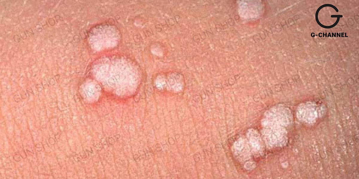 bệnh mụn cóc sinh dục nam nguyên nhân do đâu? Triệu chứng như thế nào?