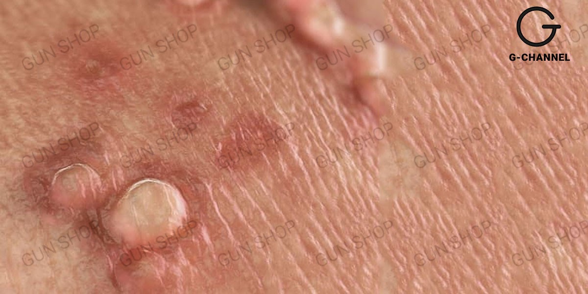 bệnh mụn cóc sinh dục nam nguyên nhân do đâu? Triệu chứng như thế nào?