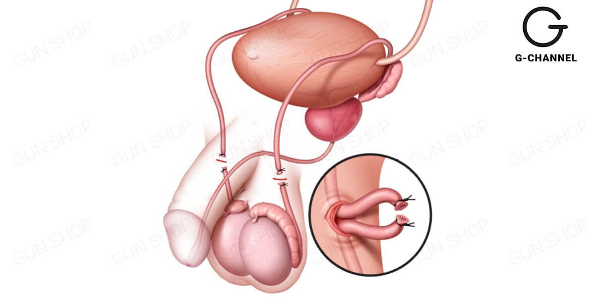 Bị tắc ống dẫn tinh có chữa được không?