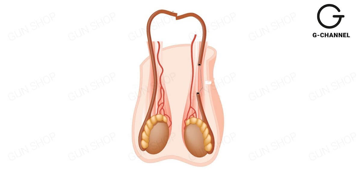 Bị tắc ống dẫn tinh có chữa được không?