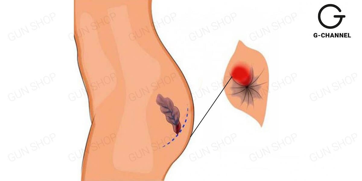 Cách làm sạch hậu môn trước khi quan hệ đúng chuẩn