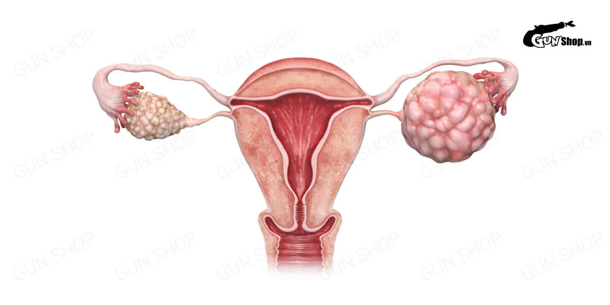 Đa nang buồng trứng có làm IVF được không?