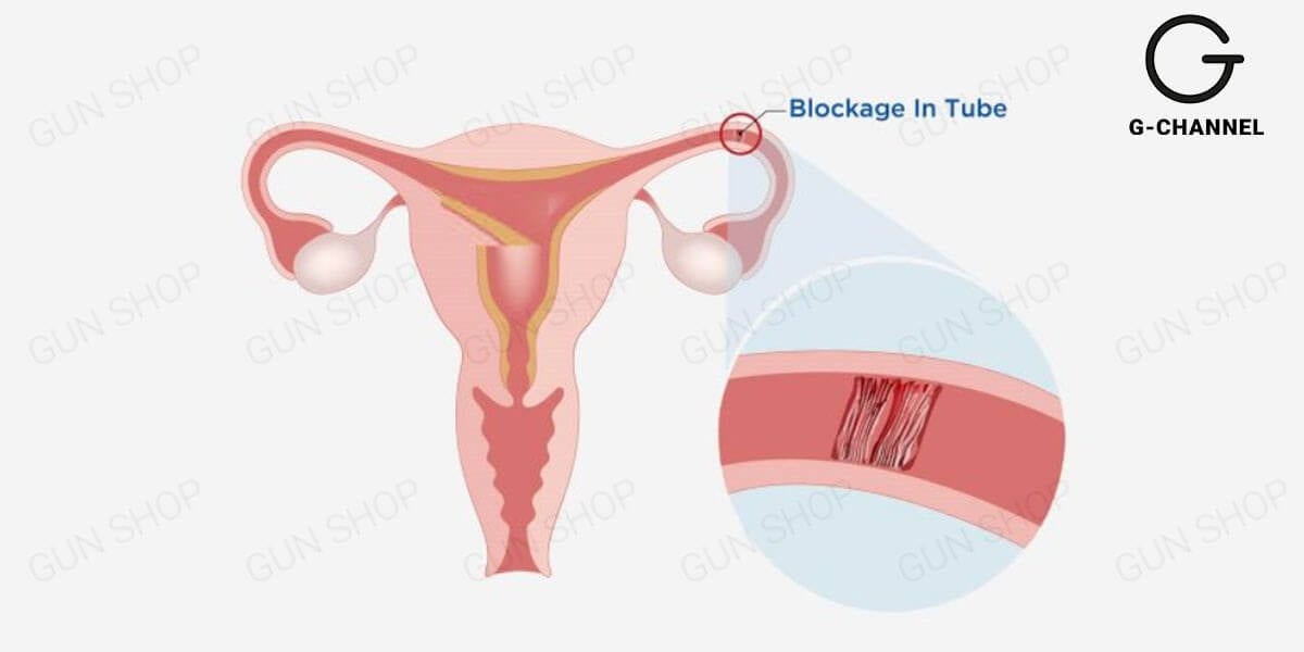 Dấu hiệu tắc ống dẫn trứng là gì?