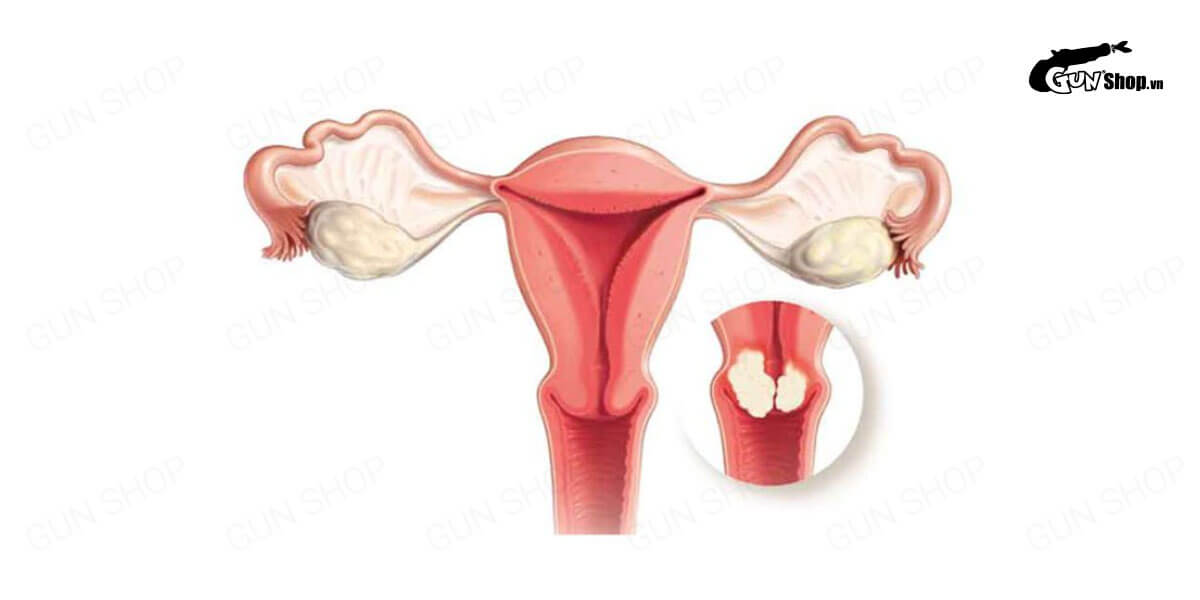 Dính buồng tử cung là gì? Nguyên nhân và cách phòng ngừa