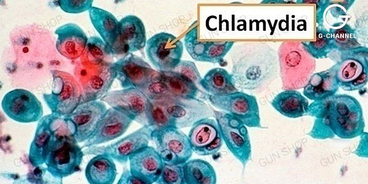 Bệnh Chlamydia Là Gì Và Cách Phòng Bệnh Chlamydia Hiệu Quả