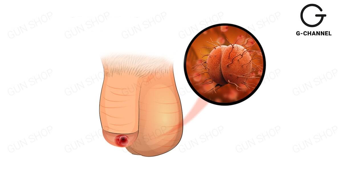 Những nguyên nhân khiến dương vật bị ngứa bên trong