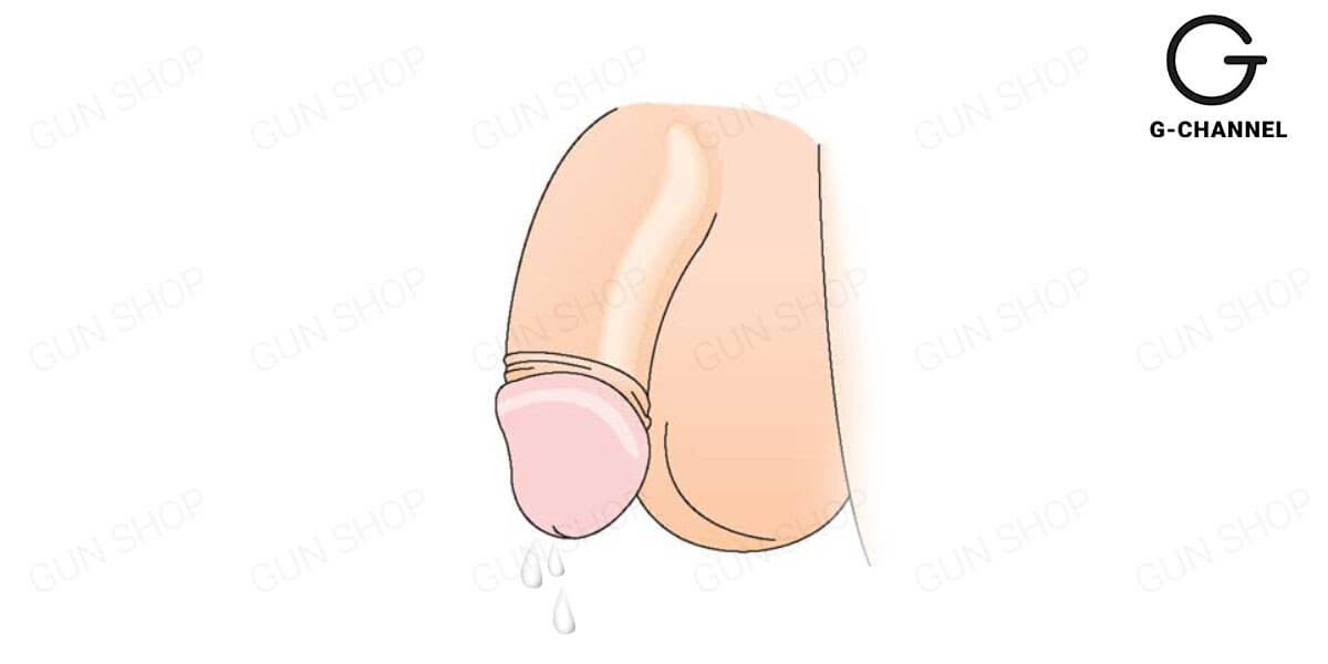 Dương vật chảy mủ là bị gì?