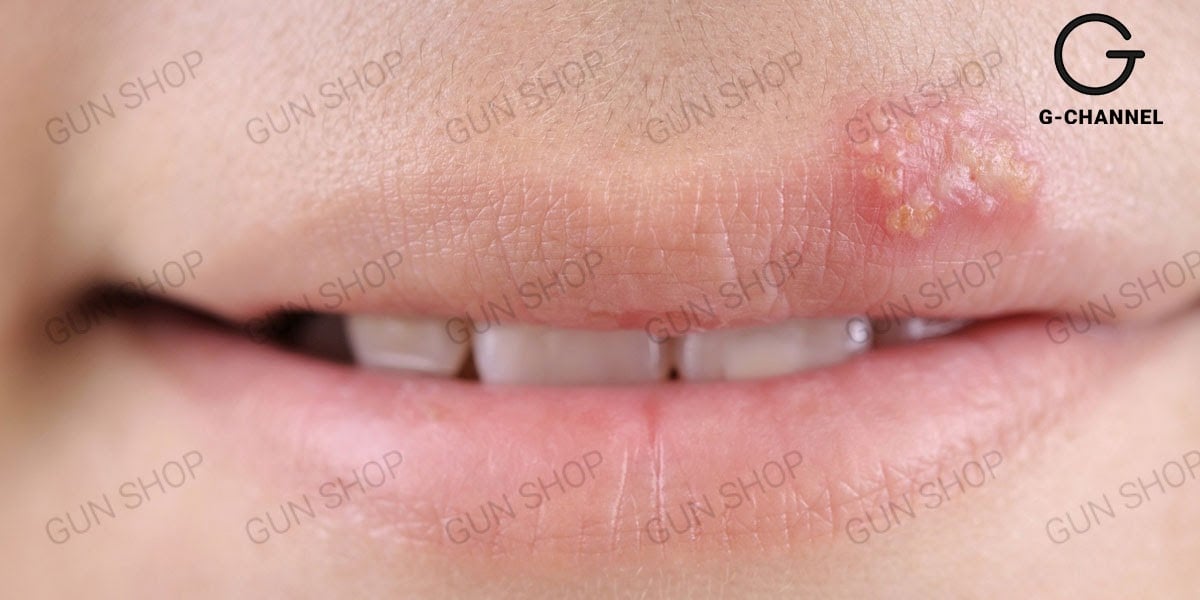 Bị Herpes môi nên kiêng ăn gì?