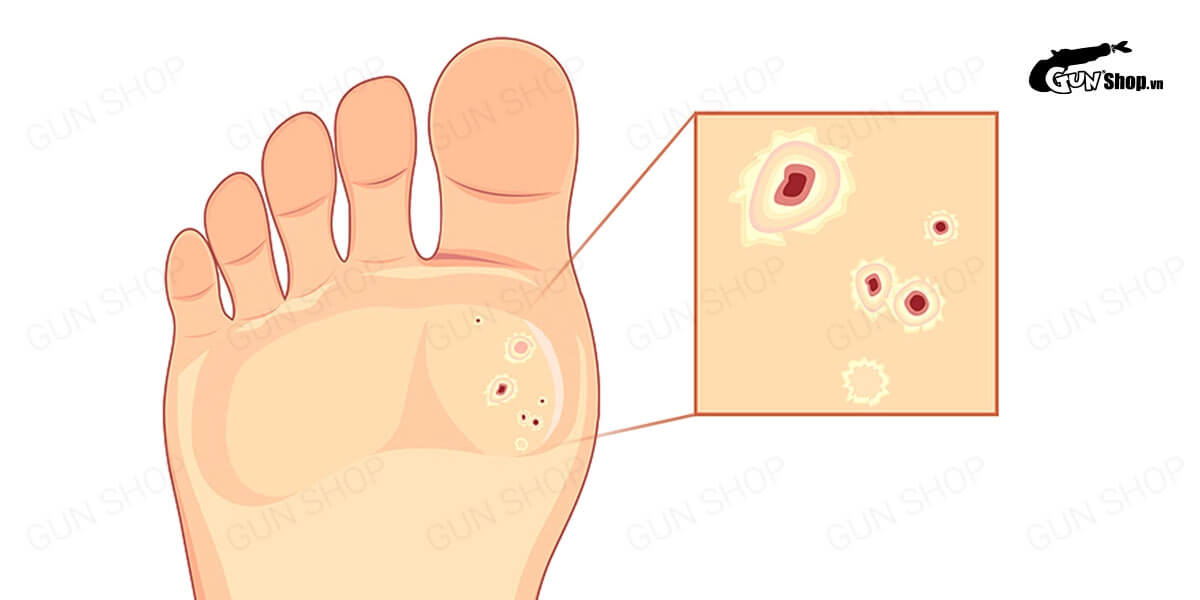 HPV - Virus lây truyền bệnh tình dục là gì? Có tổng bao nhiêu chủng?