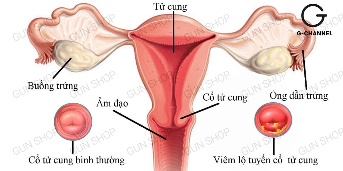 huyết trắng khí hư có màu nâu là gì? Có nguy hiểm không? Nguyên nhân là gì?