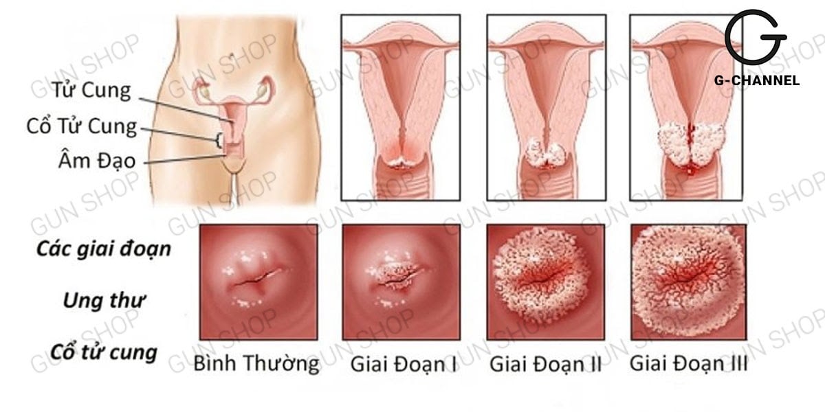 huyết trắng khí hư có màu nâu là gì? Có nguy hiểm không? Nguyên nhân là gì?