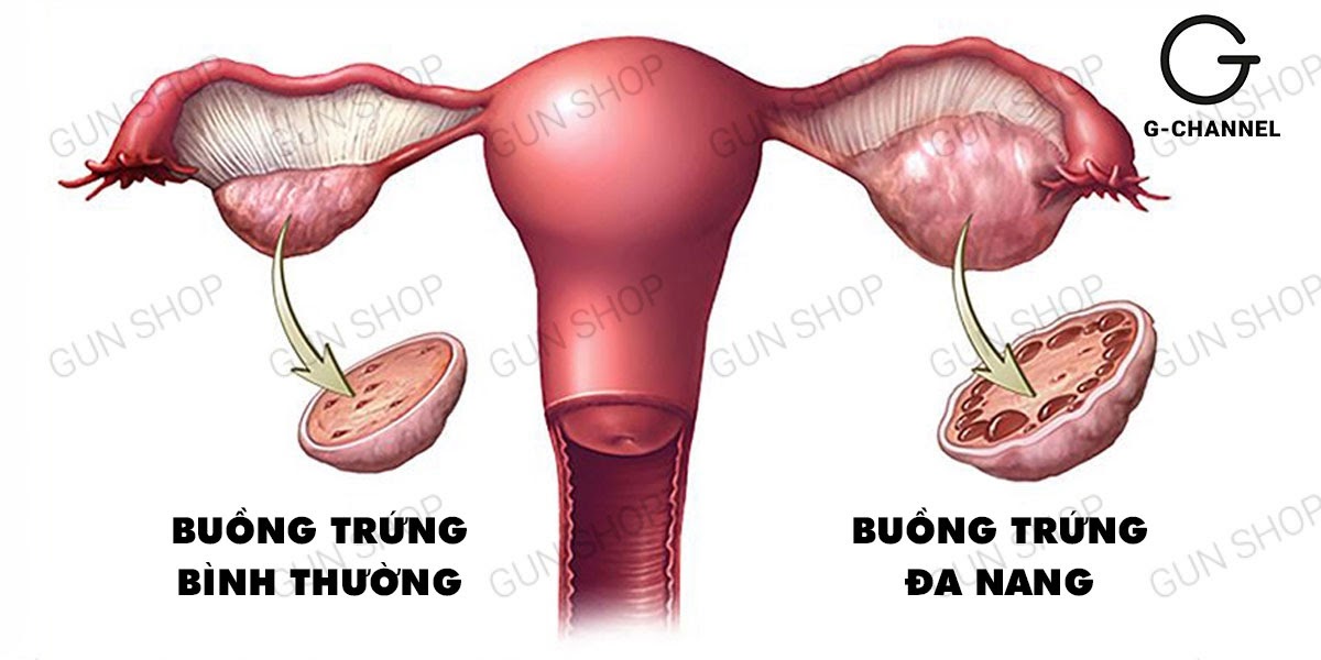 huyết trắng khí hư có màu nâu là gì? Có nguy hiểm không? Nguyên nhân là gì?