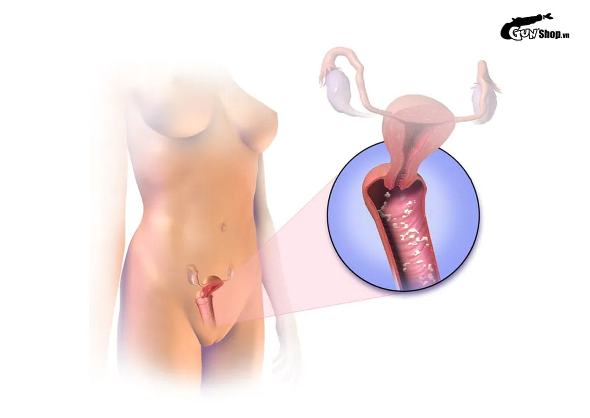 Huyết trắng ra nhiều