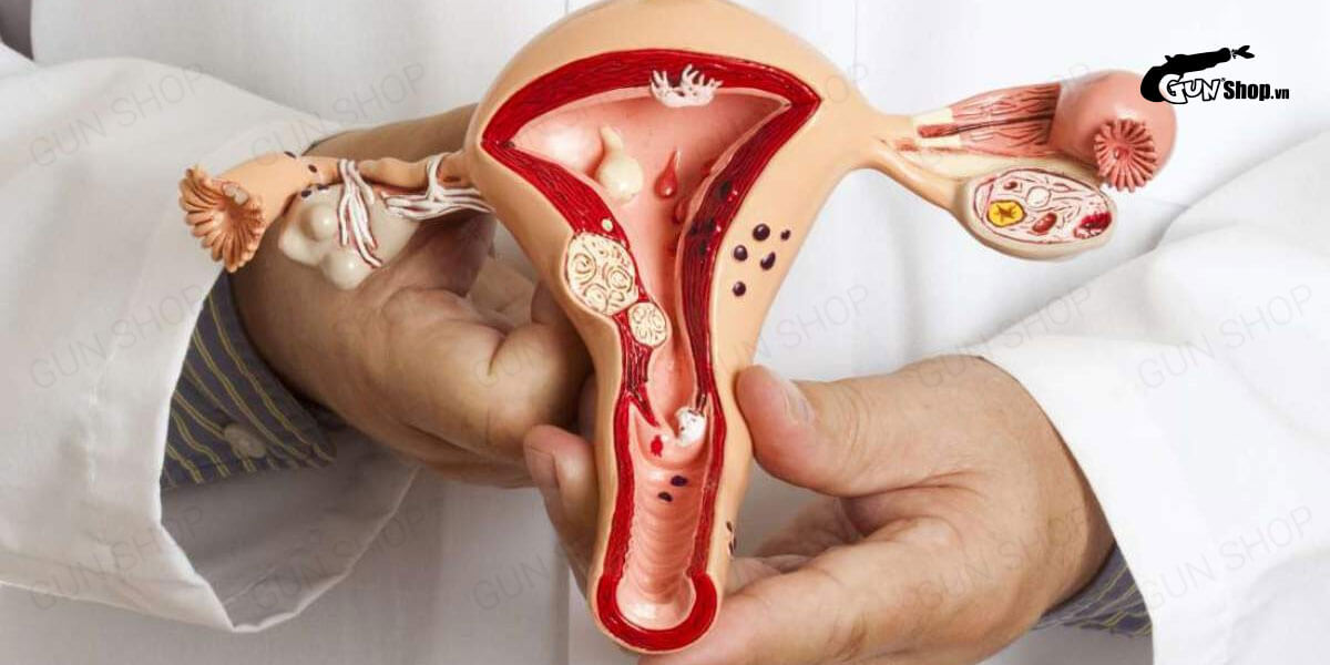 Lạc nội mạc tử cung là gì? Triệu chứng và nguyên nhân do đâu?