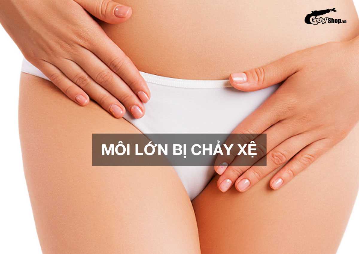Môi lớn bị chảy xệ