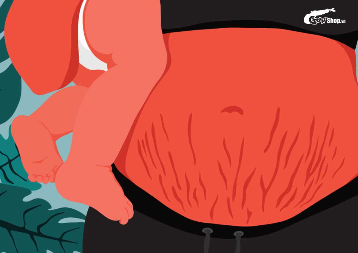 Môi lớn bị chảy xệ