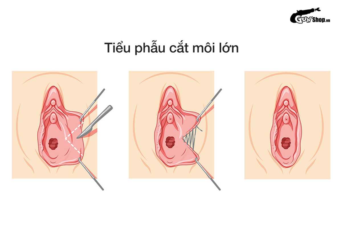 Môi lớn bị chảy xệ