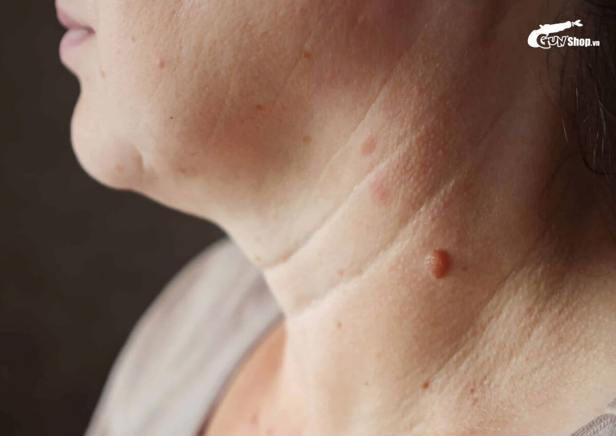 Mụn cóc có nguy hiểm không?