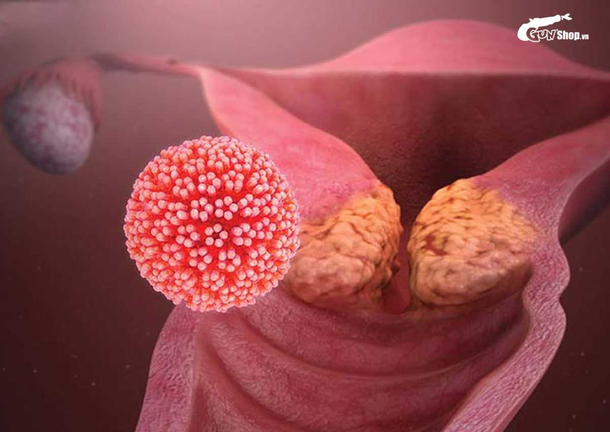 Ngủ chung có dễ lây sùi mào gà?
