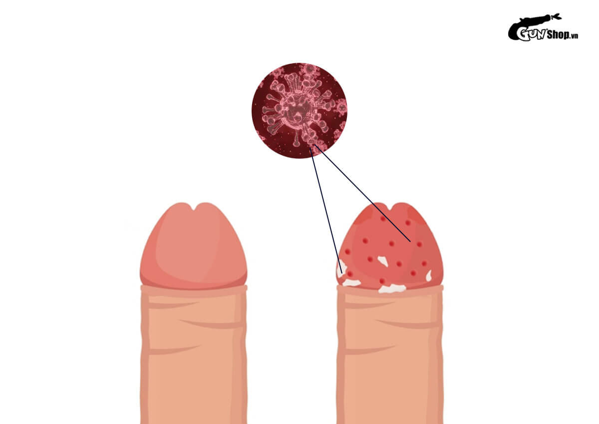 Nổi mụn nhỏ trắng ở rãnh bao quy đầu