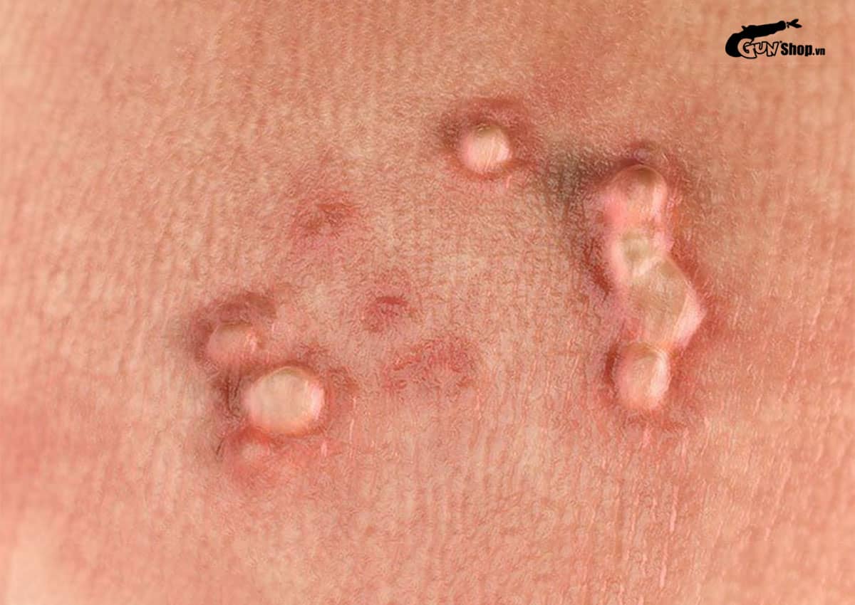 Nổi mụn nhỏ trắng ở rãnh bao quy đầu