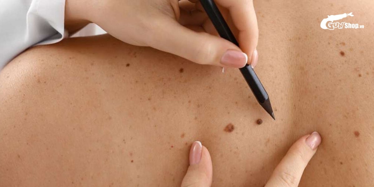 Có nên tẩy nốt ruồi ở vùng kín phụ nữ hay không?