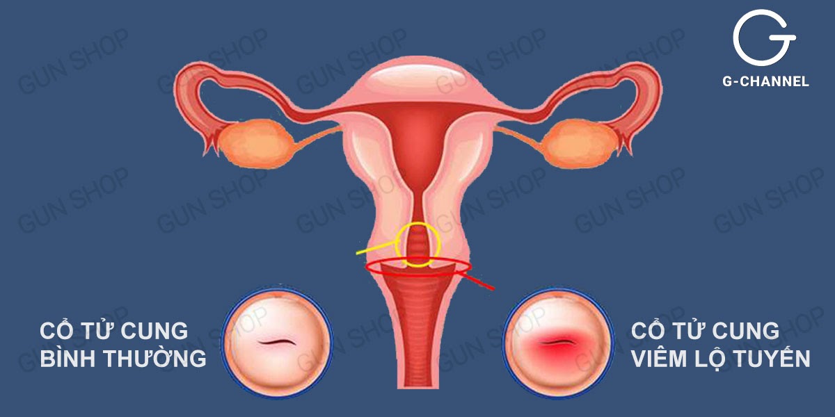 Ra huyết trắng vón cục và ngứa có sao không?